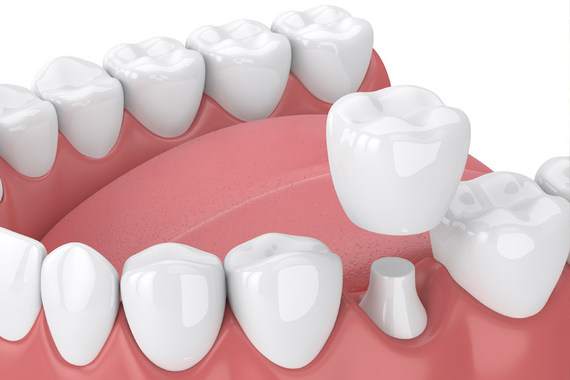 Dental Crowns in Key Largo