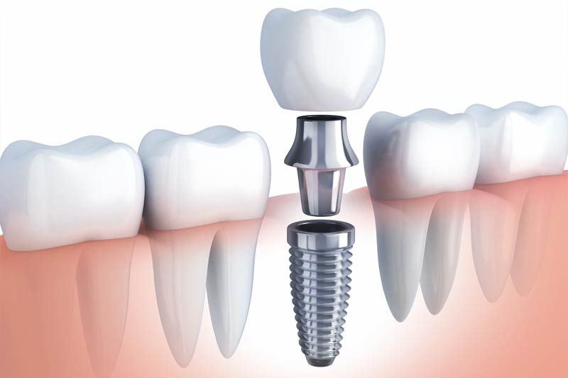 Implants Dentist in Key Largo