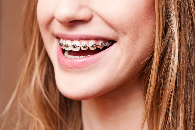 Orthodontics in Key Largo