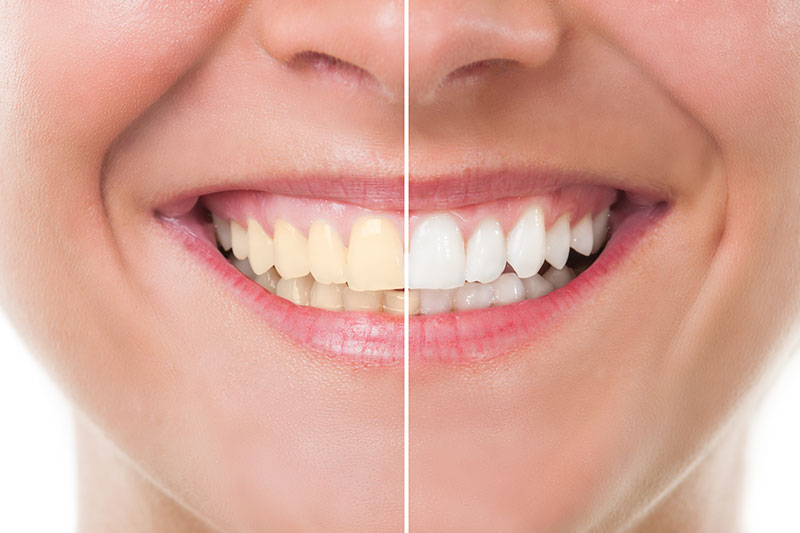 Teeth Whitening in Key Largo