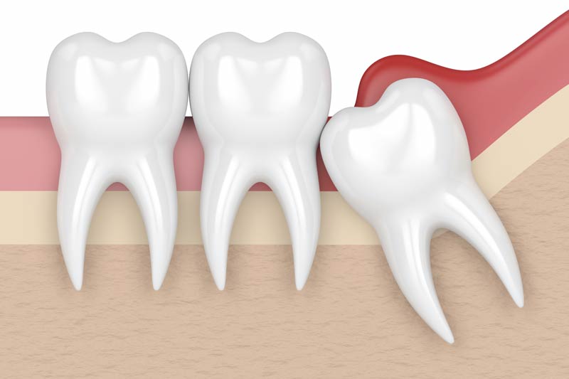 Wisdom Tooth Removal in Key Largo